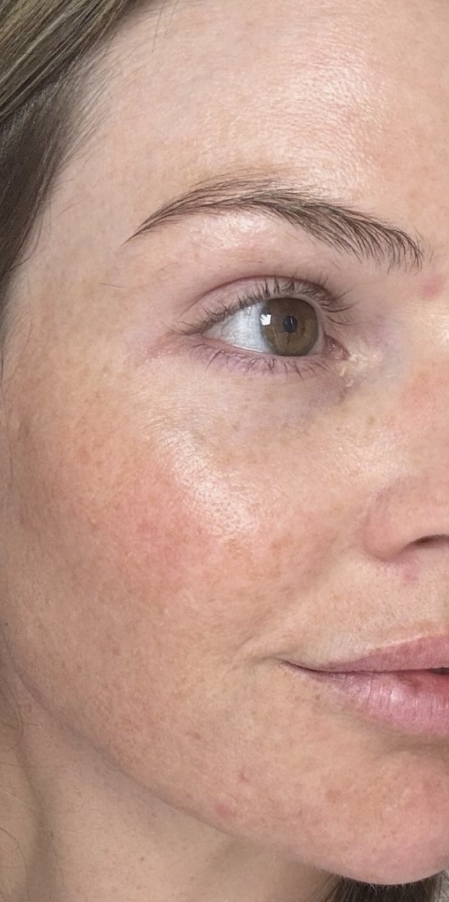 Skin after
