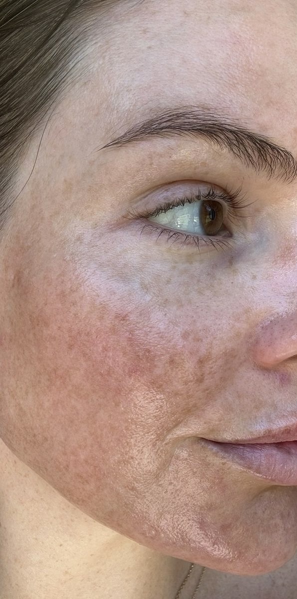 Skin before