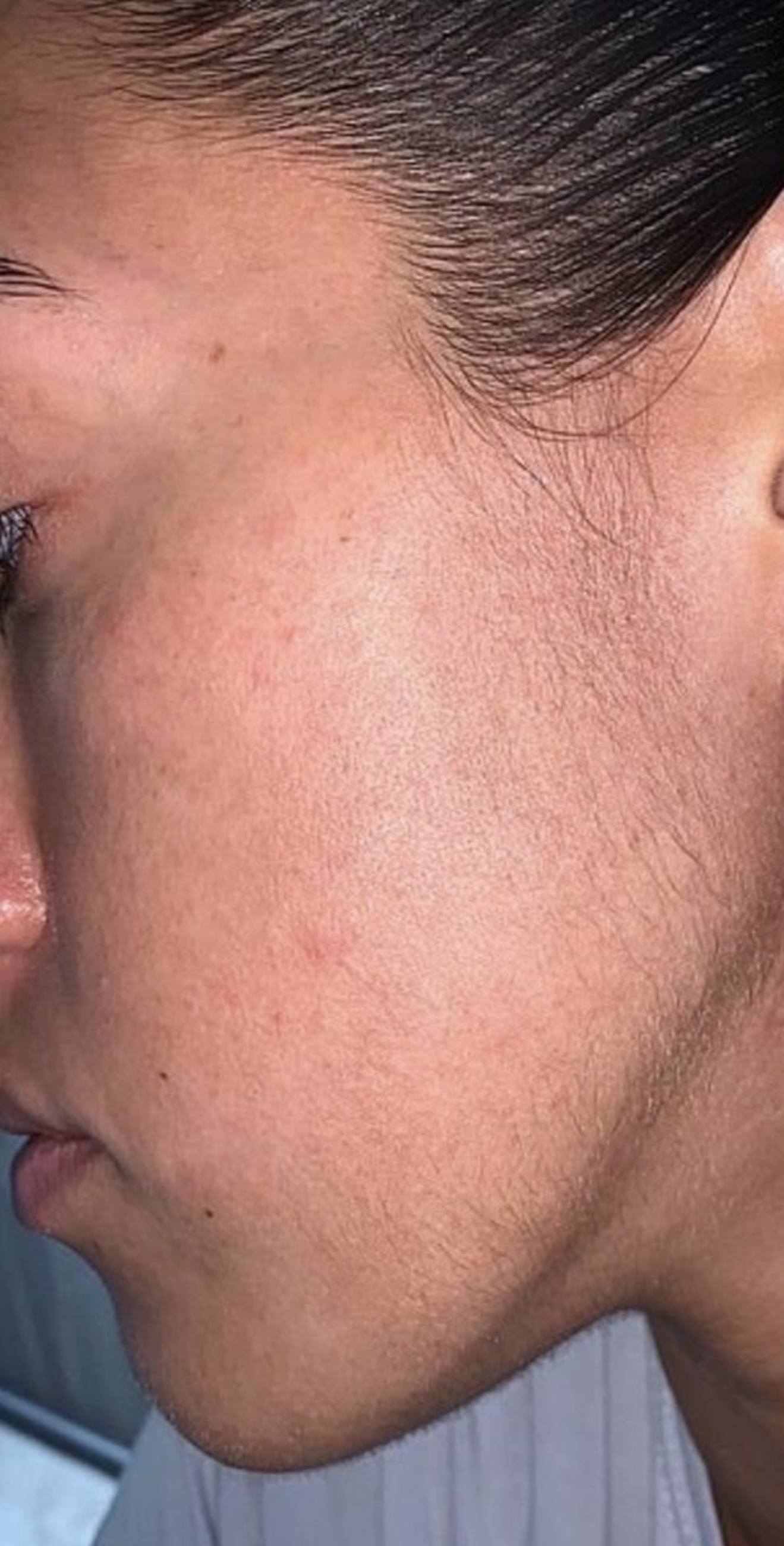 Laser before